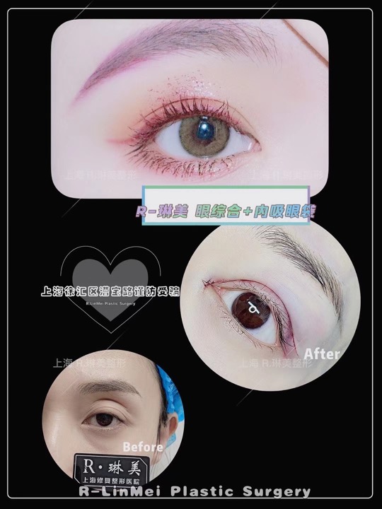 琳美整形眼综合整形 