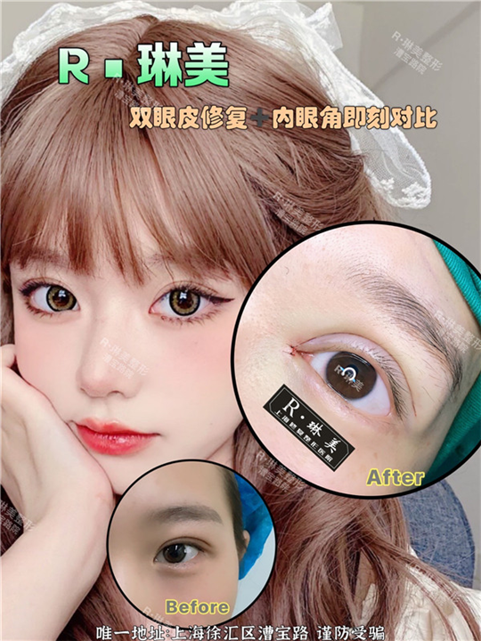 上海琳美眼综合整形