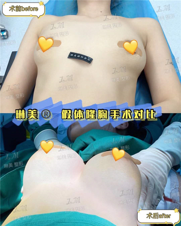 上海琳美隆胸整形