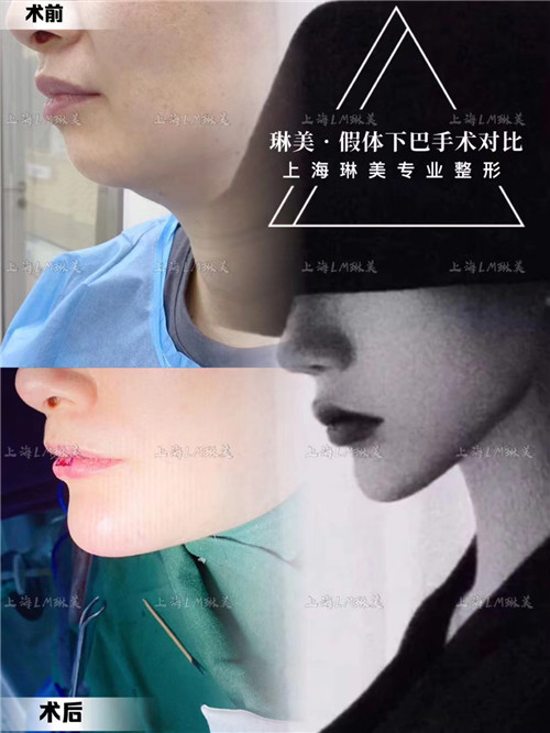 上海琳美下巴整形