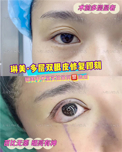 上海琳美眼综合整形