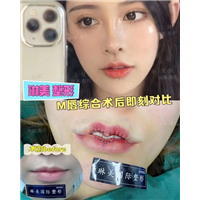 琳美整形厚唇改薄 