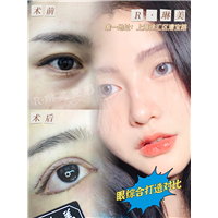 琳美整形眼综合整形 
