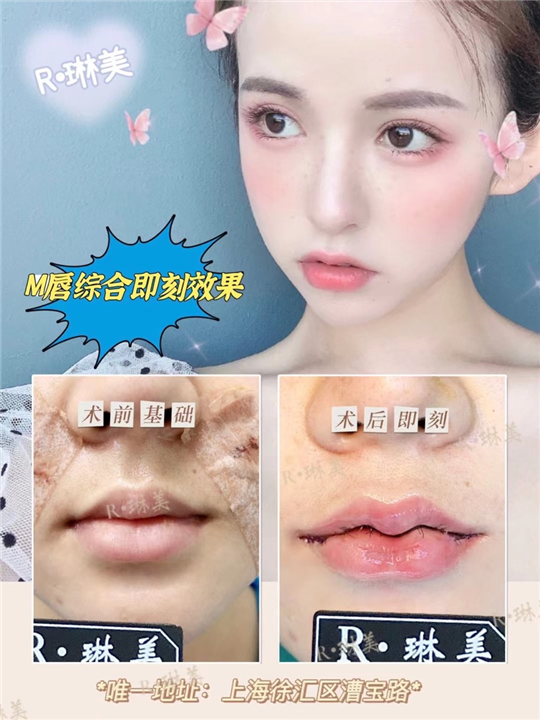 琳美唇部整形