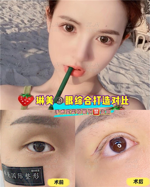 上海琳美眼综合整形