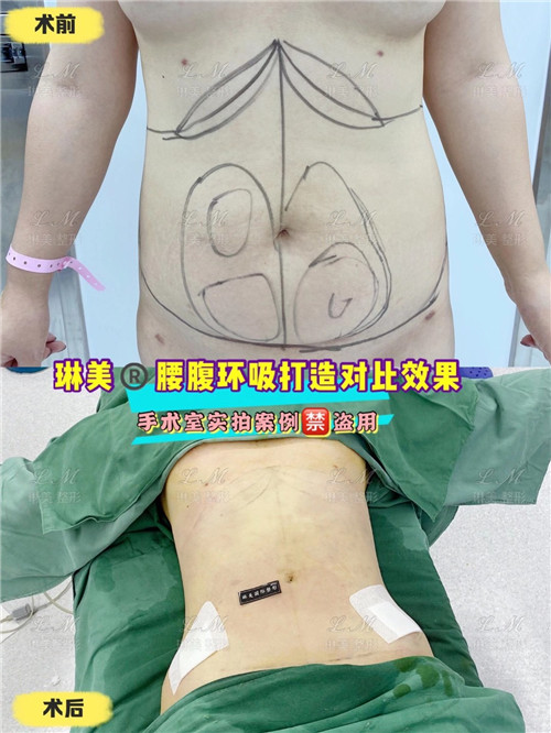 上海琳美吸脂瘦身