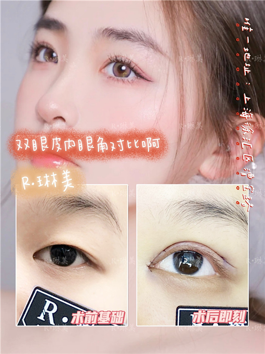 琳美整形眼综合整形 
