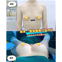 上海琳美隆胸整形