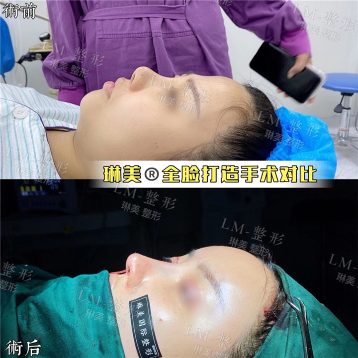 琳美整形鼻综合整形 