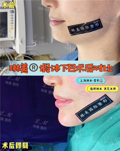 上海琳美下巴整形