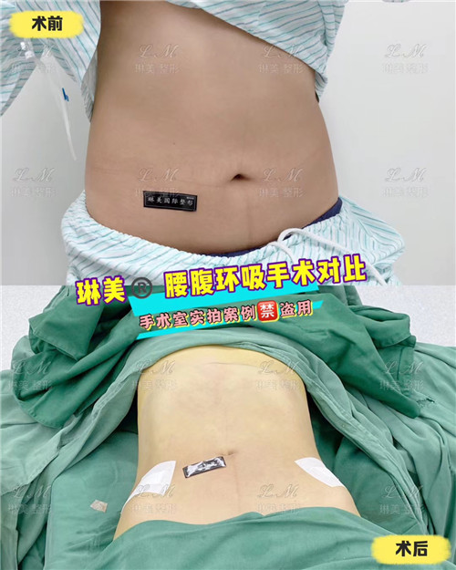 上海琳美吸脂瘦身