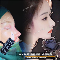琳美整形鼻综合整形 