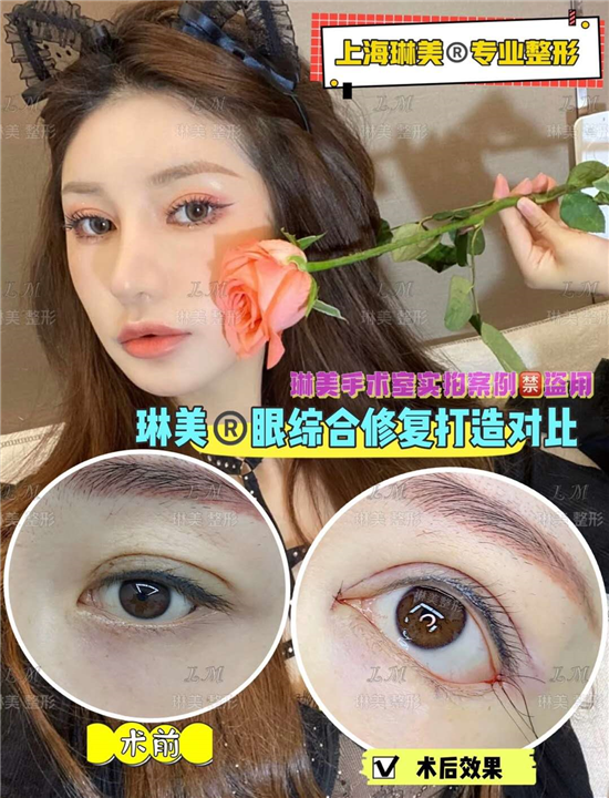 上海琳美眼综合整形