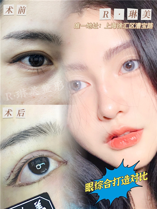 琳美整形眼综合整形 