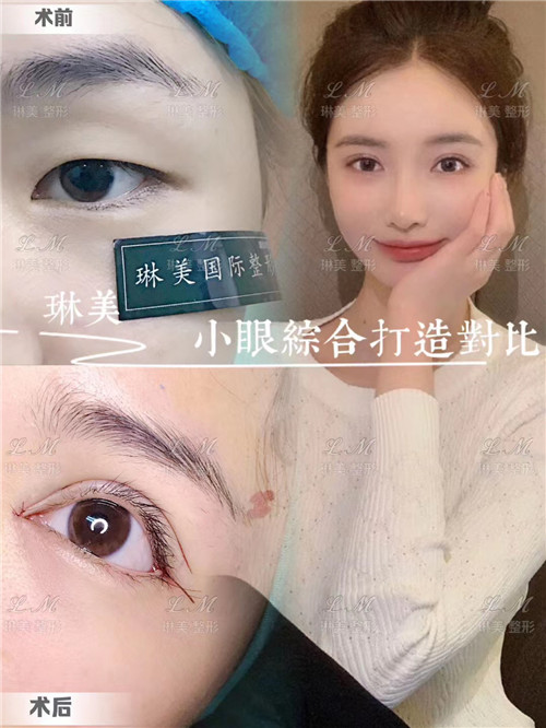 上海琳美眼综合整形