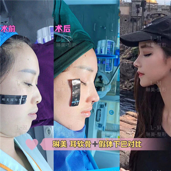 上海琳美鼻整形