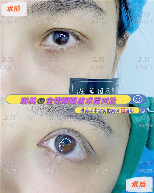 上海琳美眼综合整形