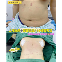 琳美吸脂整形