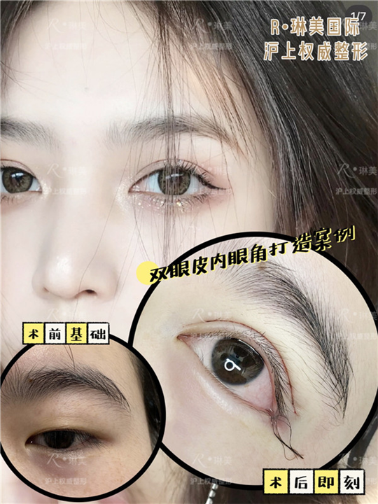 上海琳美眼综合整形