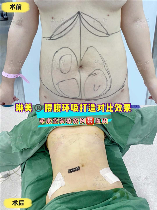 上海琳美腰腹吸脂