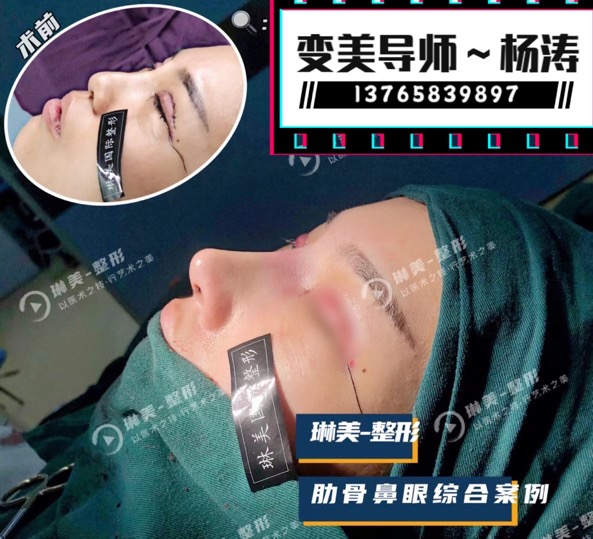 琳美整形鼻综合整形 