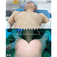 上海琳美隆胸整形
