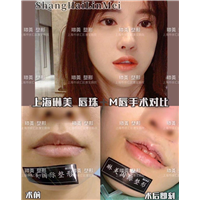 上海琳美M唇整形