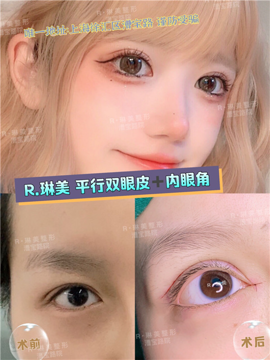 上海琳美眼综合整形