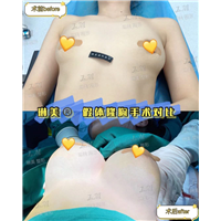 上海琳美隆胸整形
