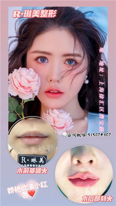 琳美唇部整形