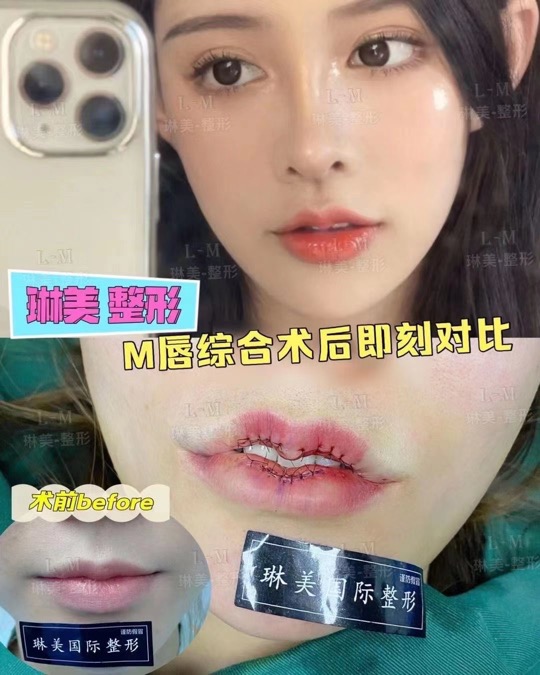 琳美整形厚唇改薄 