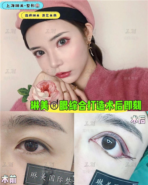 上海琳美眼综合整形
