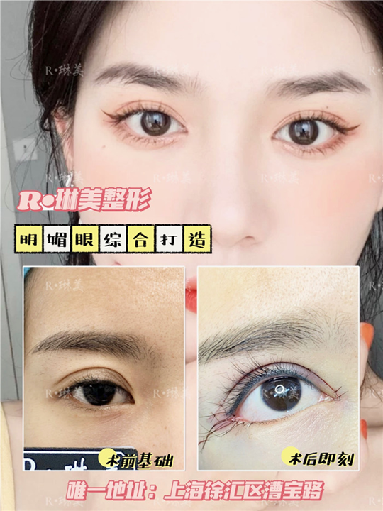 琳美整形眼综合整形 