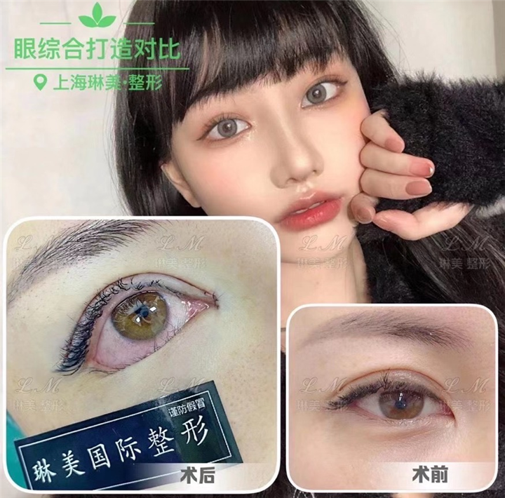 琳美眼部整形