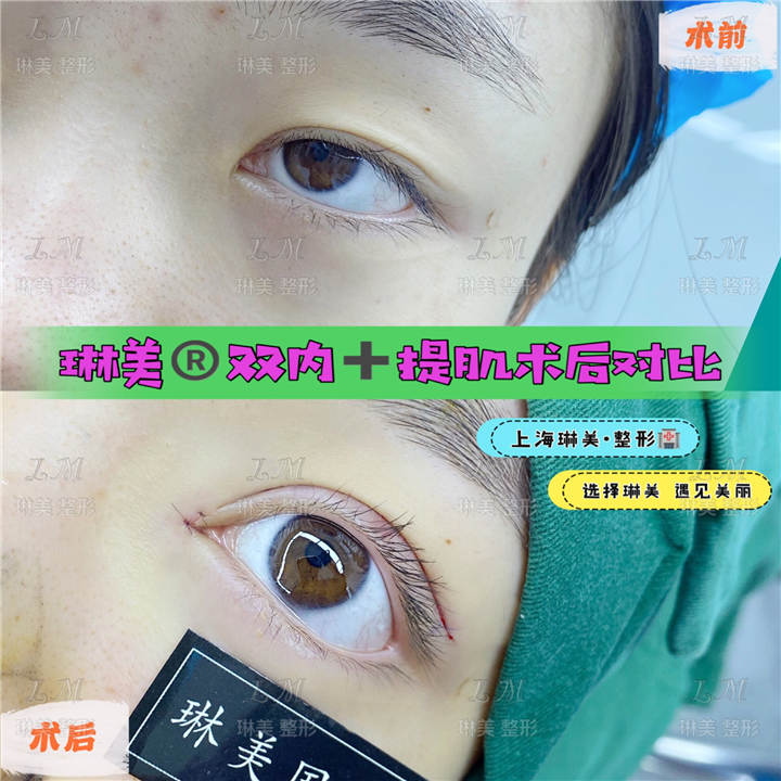 上海琳美眼综合整形