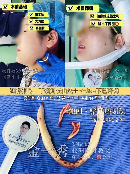 上海磨骨整形专家 