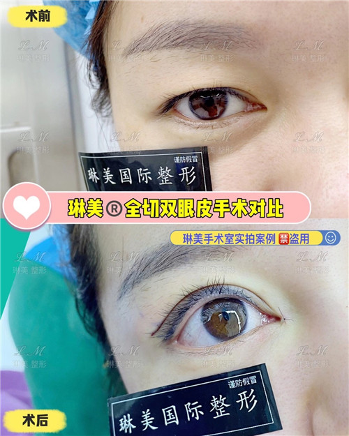 上海琳美眼综合整形