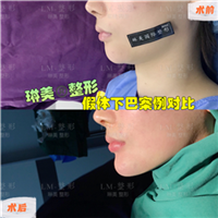 上海琳美下巴整形