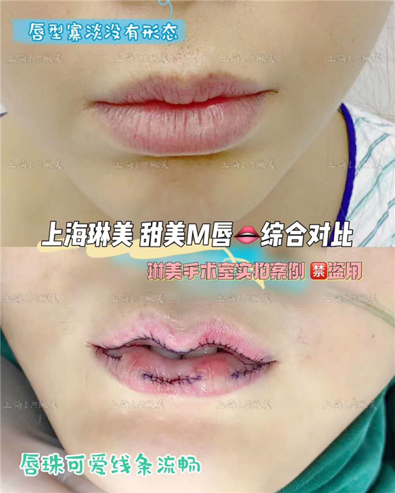 上海琳美M唇整形