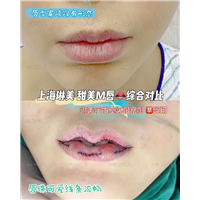 上海琳美M唇整形