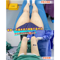 上海琳美吸脂瘦身