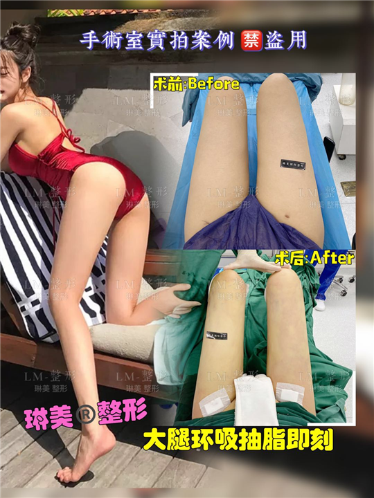 上海琳美吸脂瘦身