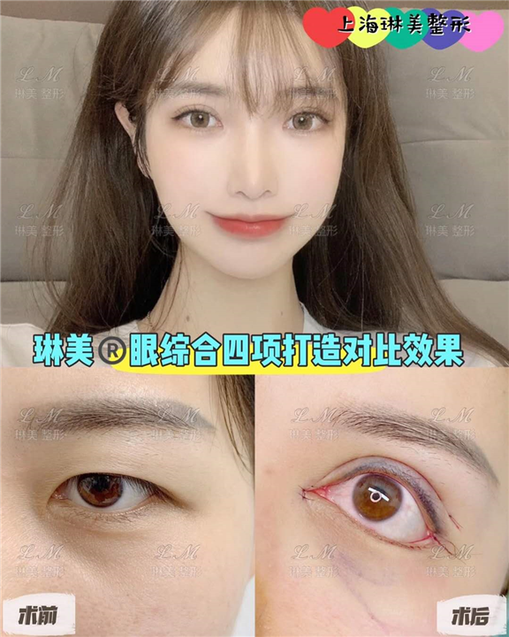 上海琳美眼综合整形