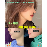 上海琳美下巴整形