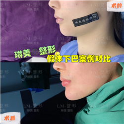 上海琳美下巴整形