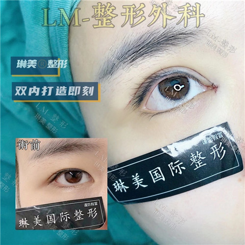 上海琳美眼综合整形