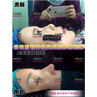 琳美整形鼻综合整形 
