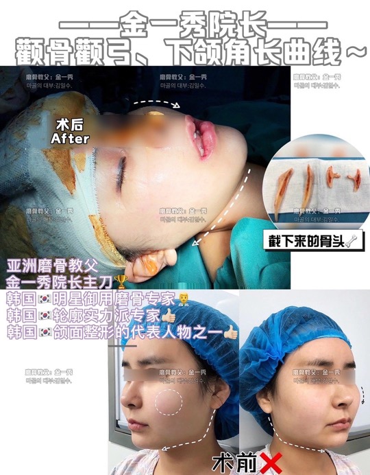 上海专业磨骨专家 
