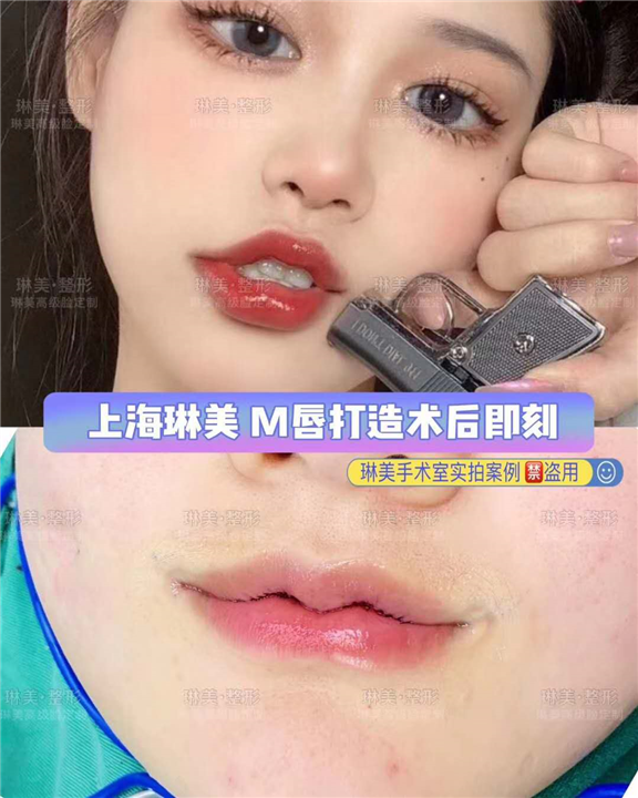 上海琳美M唇整形