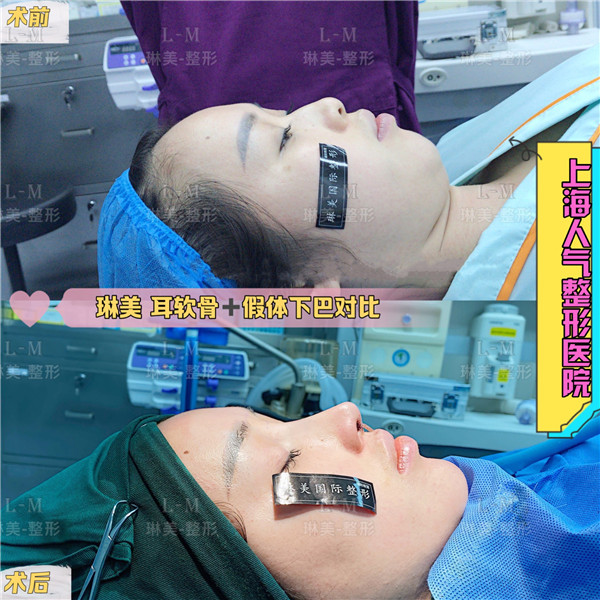 上海琳美鼻整形